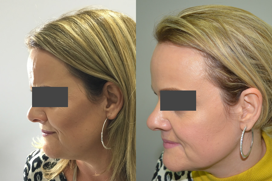 Before and after Botox - frown lines