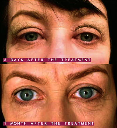 Blepharoplasty-3-days-and-1-month-after1-wr