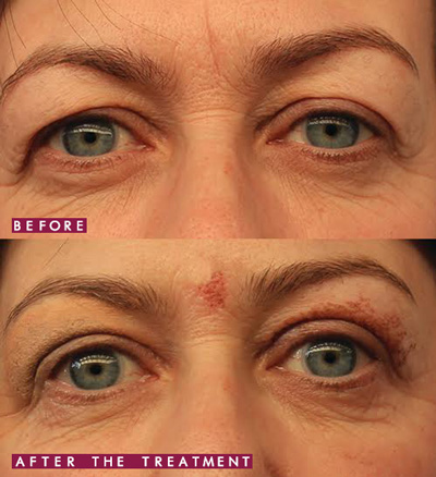 Blepharoplasty-Before-and-immediately-after1-wr