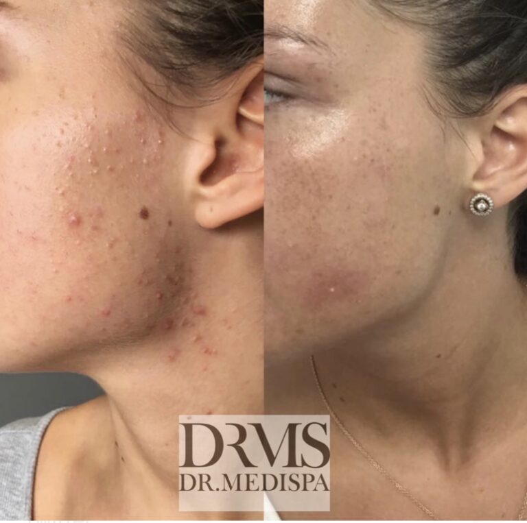 Clear Skin Acne Laser Dr MediSpa Award Winning Clinics