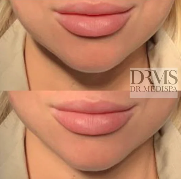 Lip Enhancement Dr MediSpa Award Winning Clinics