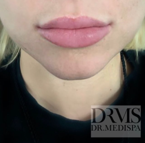 Lip Enhancement - Dr MediSpa Award Winning Clinics