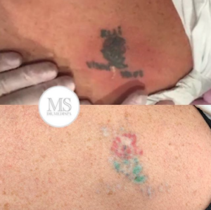 Laser Tattoo Removal - Dr MediSpa Award Winning Clinics