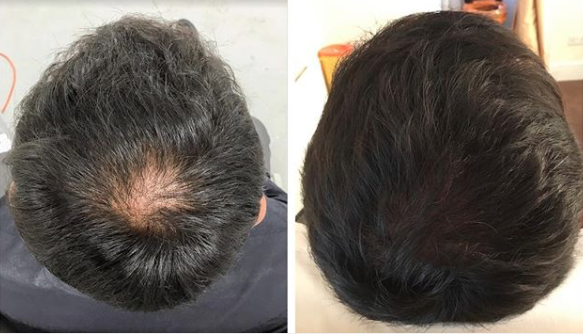 DRMS hair loss treatment results