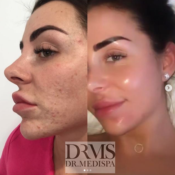 Before and after Acne treatment at Dr Medispa