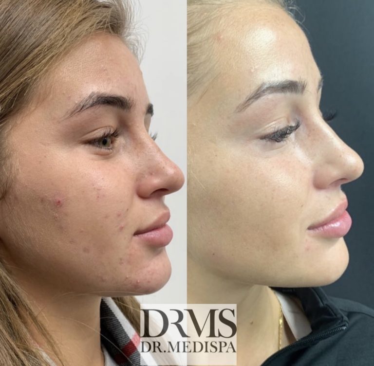 Before and after Acne treatment at Dr Medispa