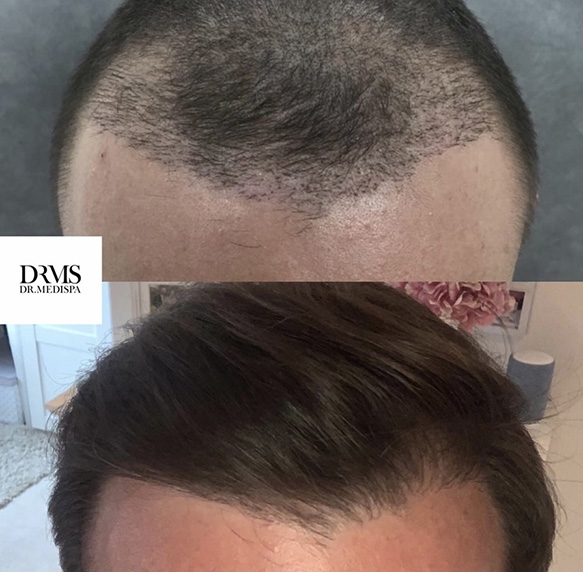 Hair loss treatment results by DRMS