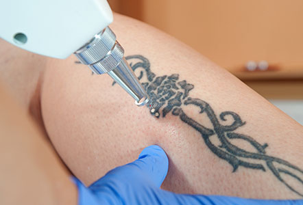 Tattoo Removal Essex: Safe Laser Removal in a Clinical Setting - Dr MediSpa  Award Winning Clinics
