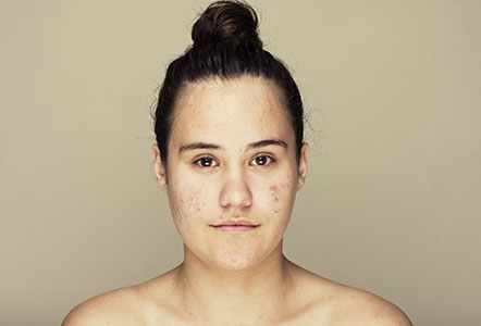 Acne and acne scarring