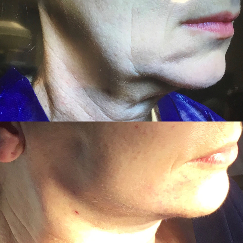 contouring to jawline and neck