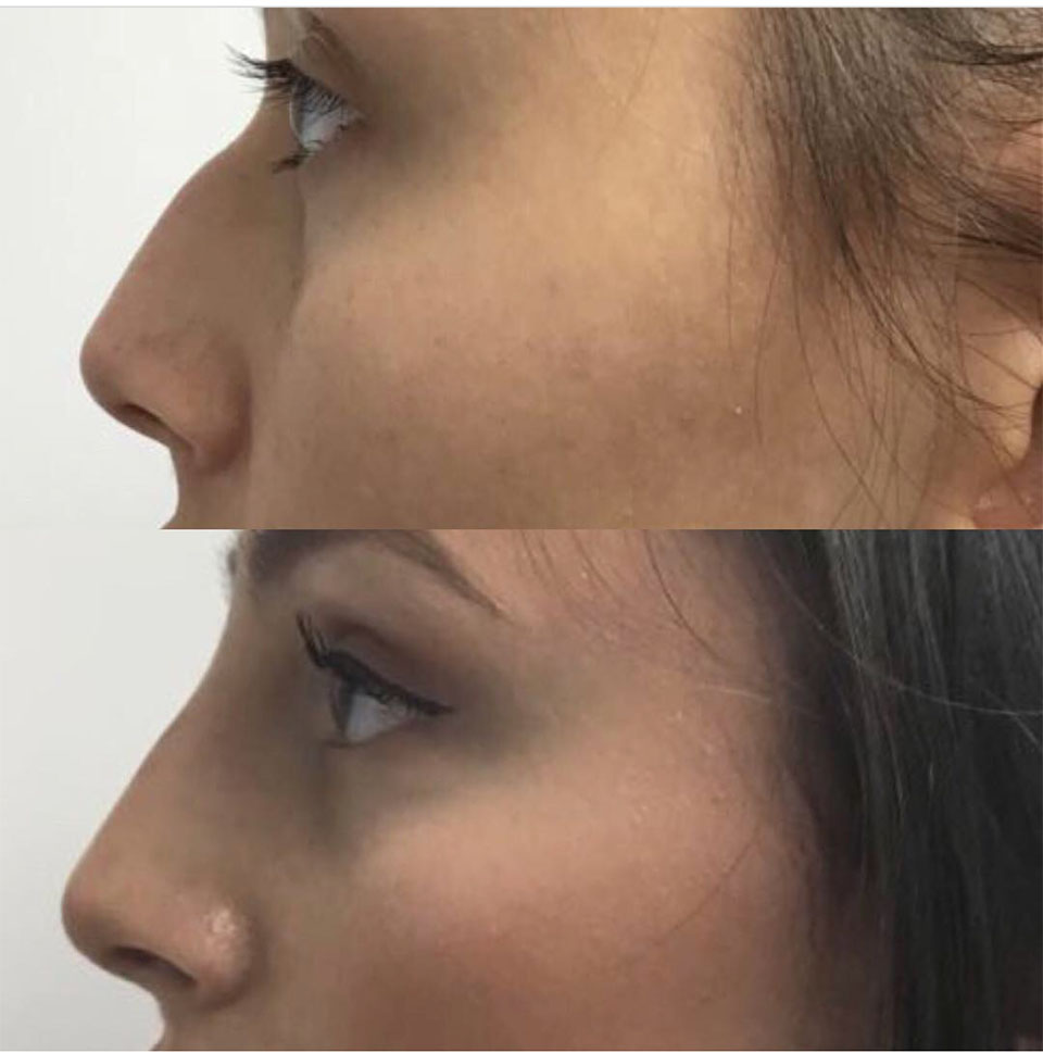 Nose contouring with filler