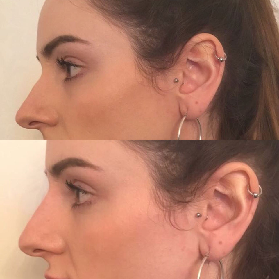 nose-contouring