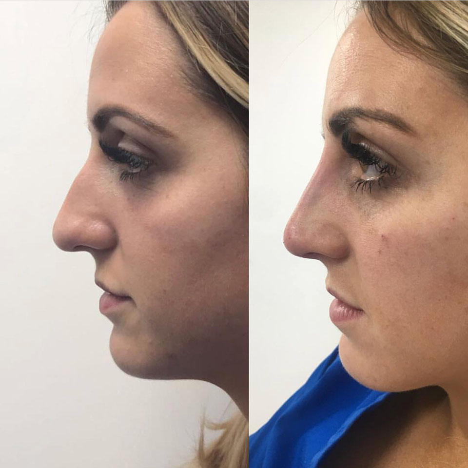 Nose contouring