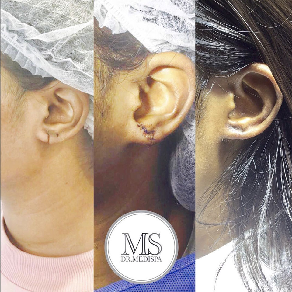 Earlobe repair Dr MediSpa Essex & London Dr MediSpa Essex & London