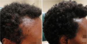 somji alopecia prp