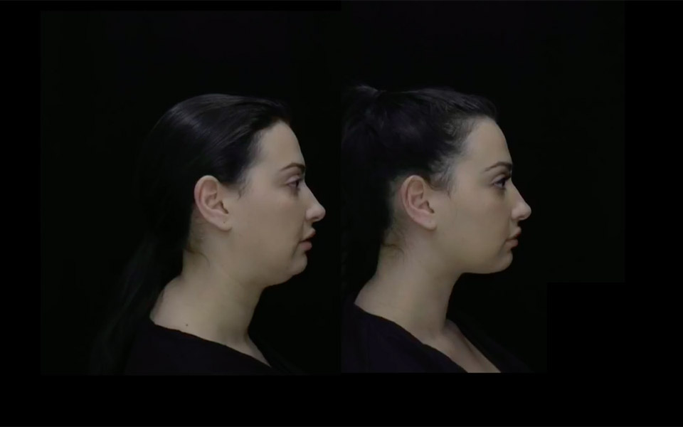 Before and after an Ellevate® treatment side view