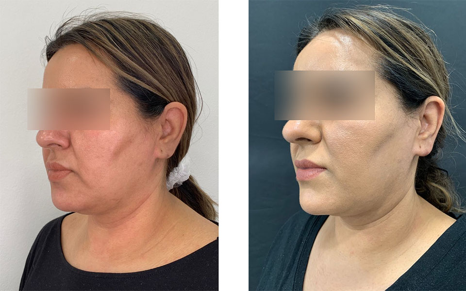 Before and after Evoke skin remodelling