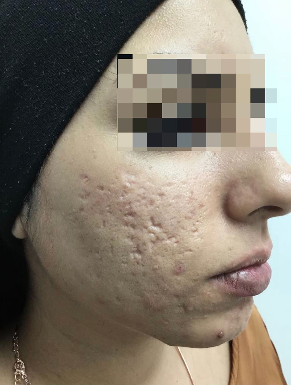 before subcision for acne scarring