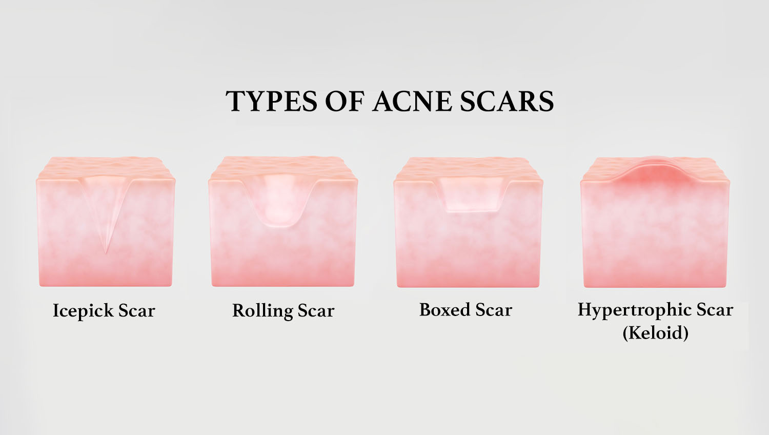 Type of acne scar