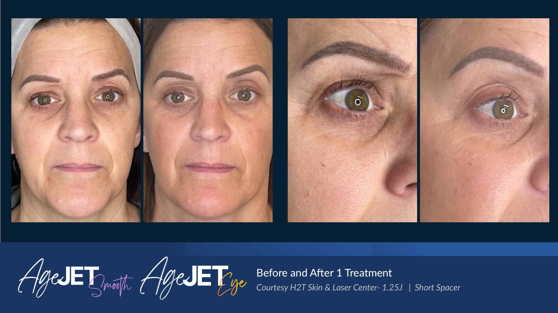 AgeJET Before and AftersAgeJet Smooth and Eye_H2T Skin_Laser