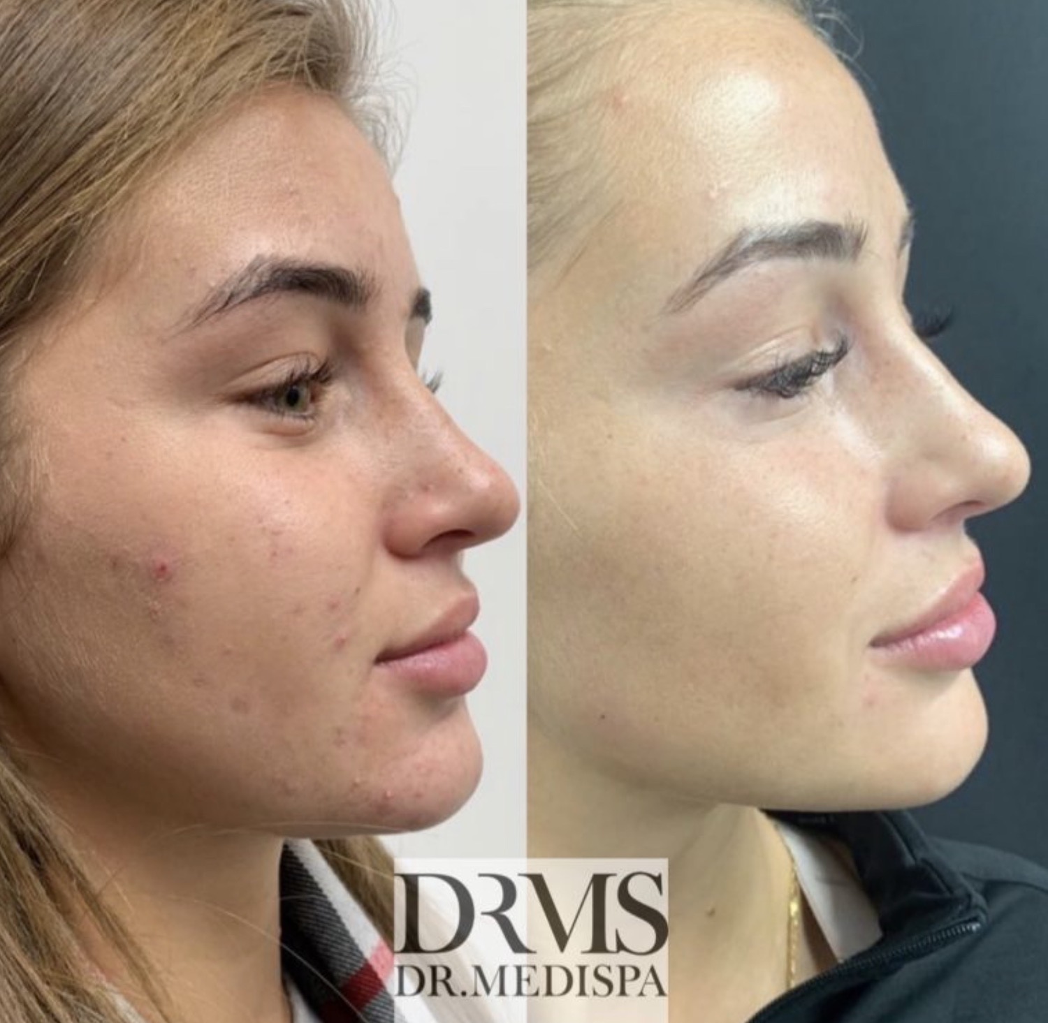 Acne Before After Treatment