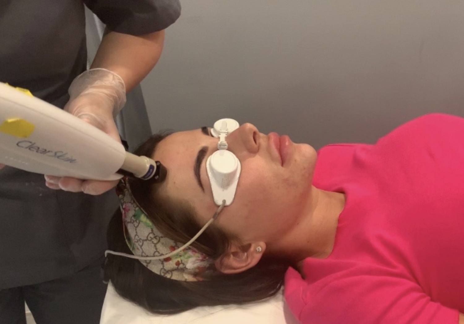 Acne Treatment