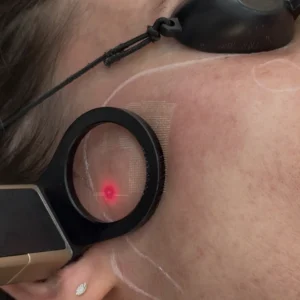 30% off C02 Laser single session