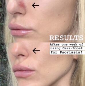 Skincare - psoriasis