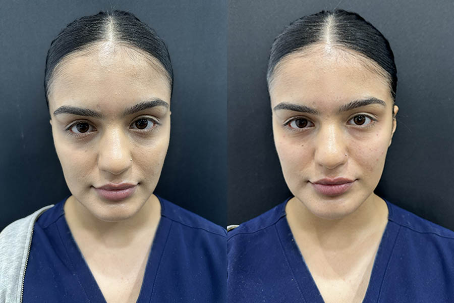 before and after polynucleotide treatm,ent