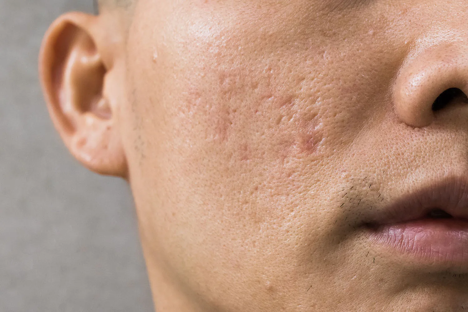 Acne Scar Removal Malaysia